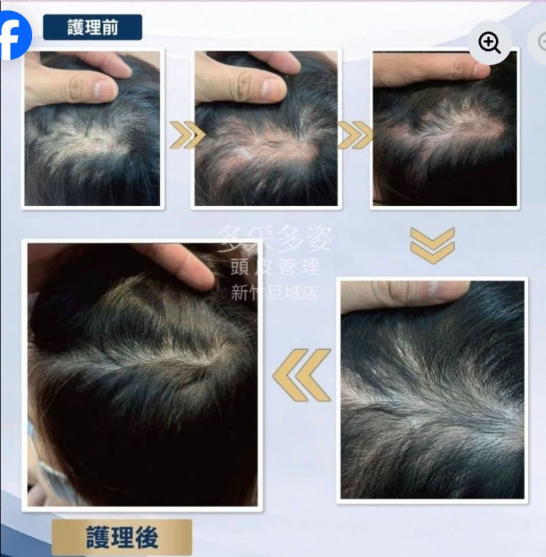 【亞太頭皮顧問專欄】在最熱的 7 月，給頭皮一處樹蔭