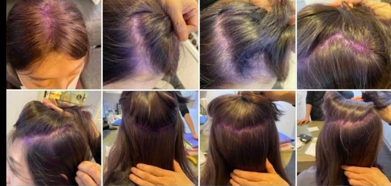 【亞太頭皮顧問專欄】中秋烤肉後，頭皮為什麼又油又臭？